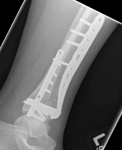 Distal tibia plate 6